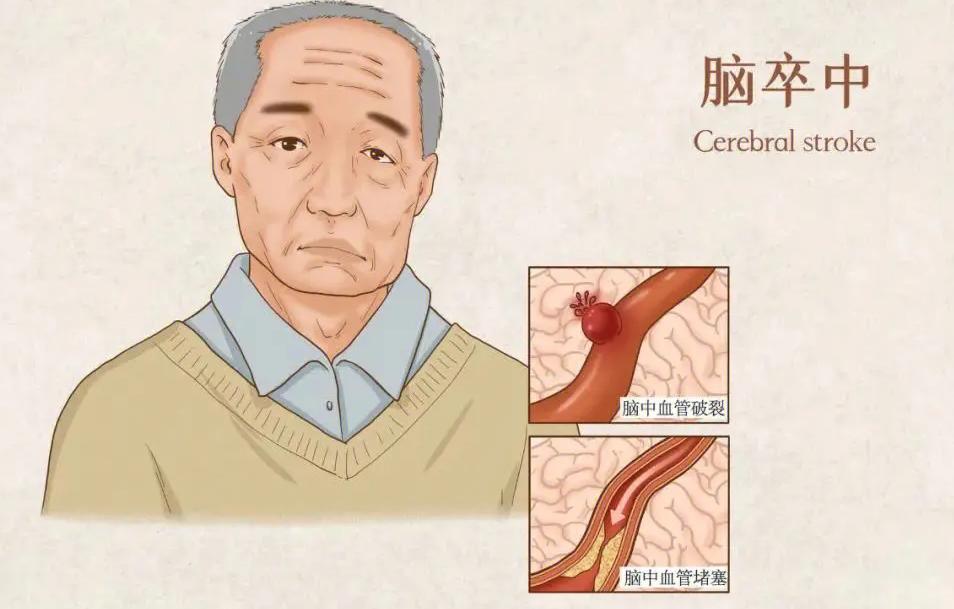 干细胞治疗脑疾病案例,干细胞治疗脑卒中3期临床试验