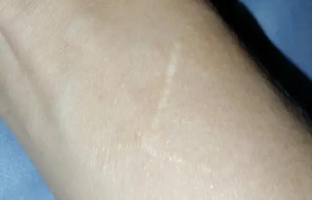 伤口缝合留疤还是不缝合留疤,可吸收的缝合线有疤痕吗