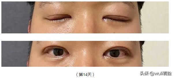 男生割双眼皮的意思,男生眼睛小割双眼皮会好看吗