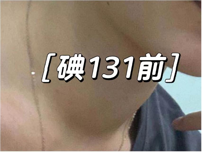 碘131治疗患者自述,甲亢患者治愈分享