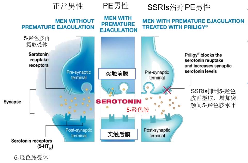 治疗*泄早**的达泊西汀，服用后为什么会无效呢？