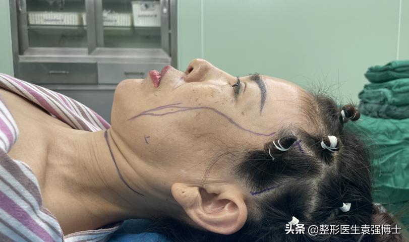 北京做大拉皮前后对比照片图文,面部做大拉皮提升的真实案例