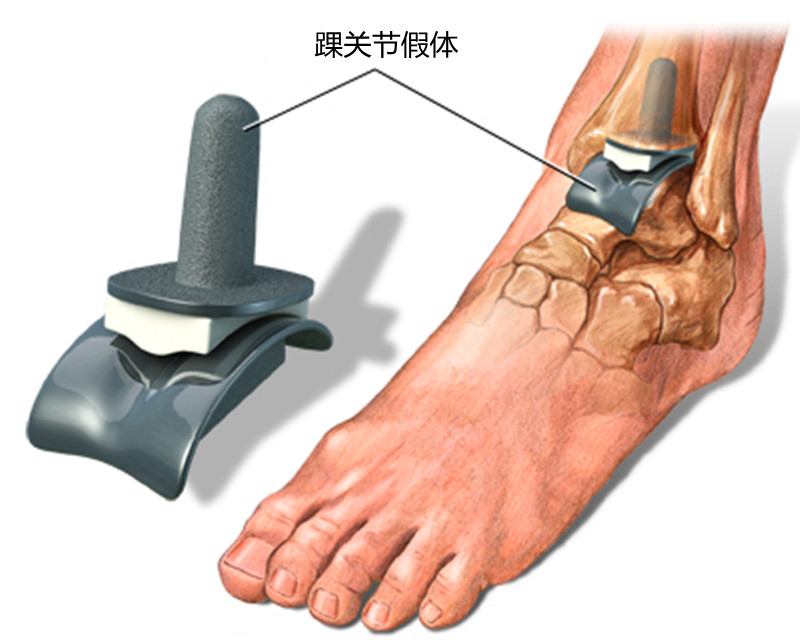 习惯性崴脚踝关节咔咔响怎么治疗,习惯性崴脚加强踝关节力量有用吗