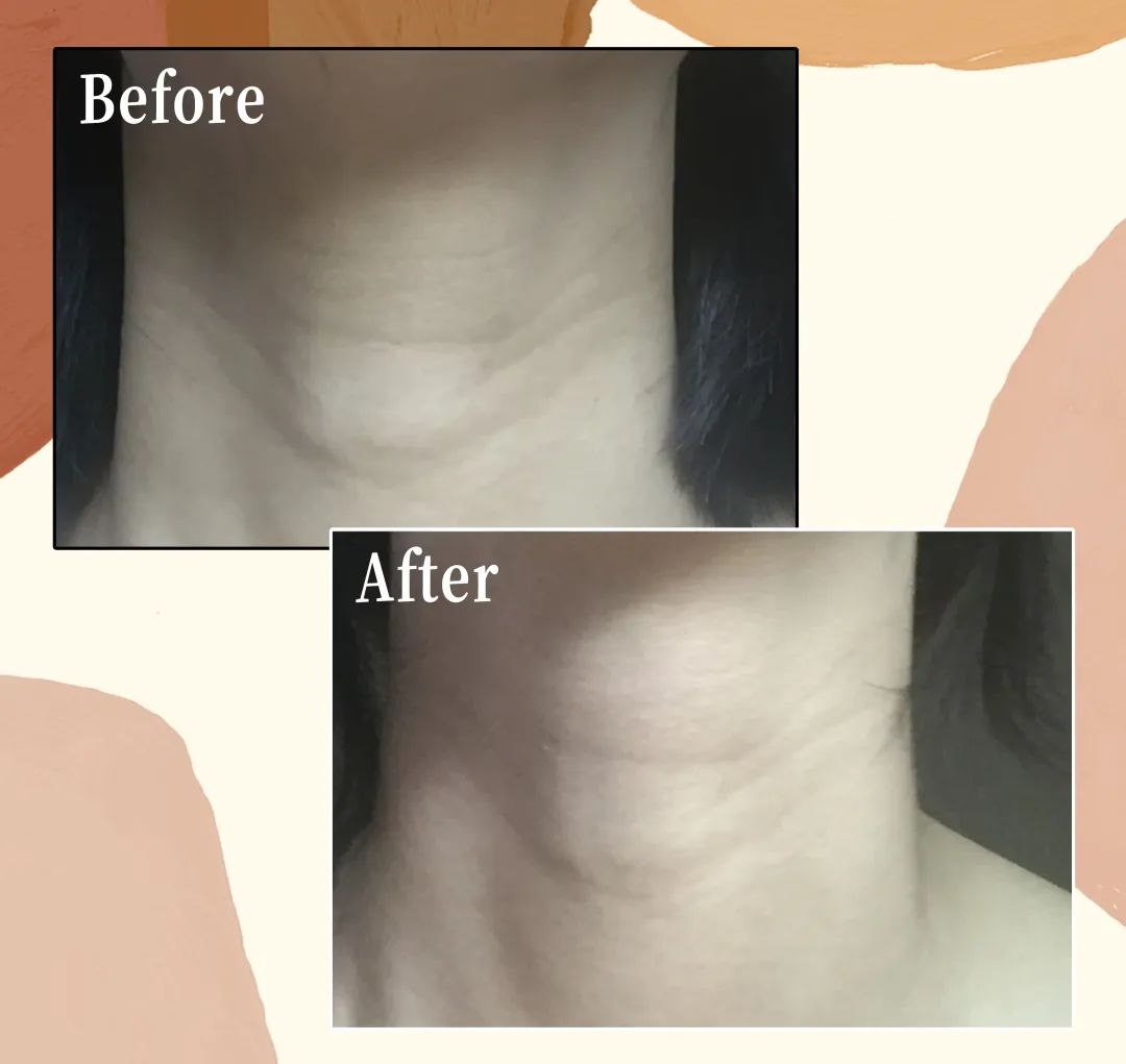 1条颈纹=显老10岁，可怕的颈纹还有救吗？