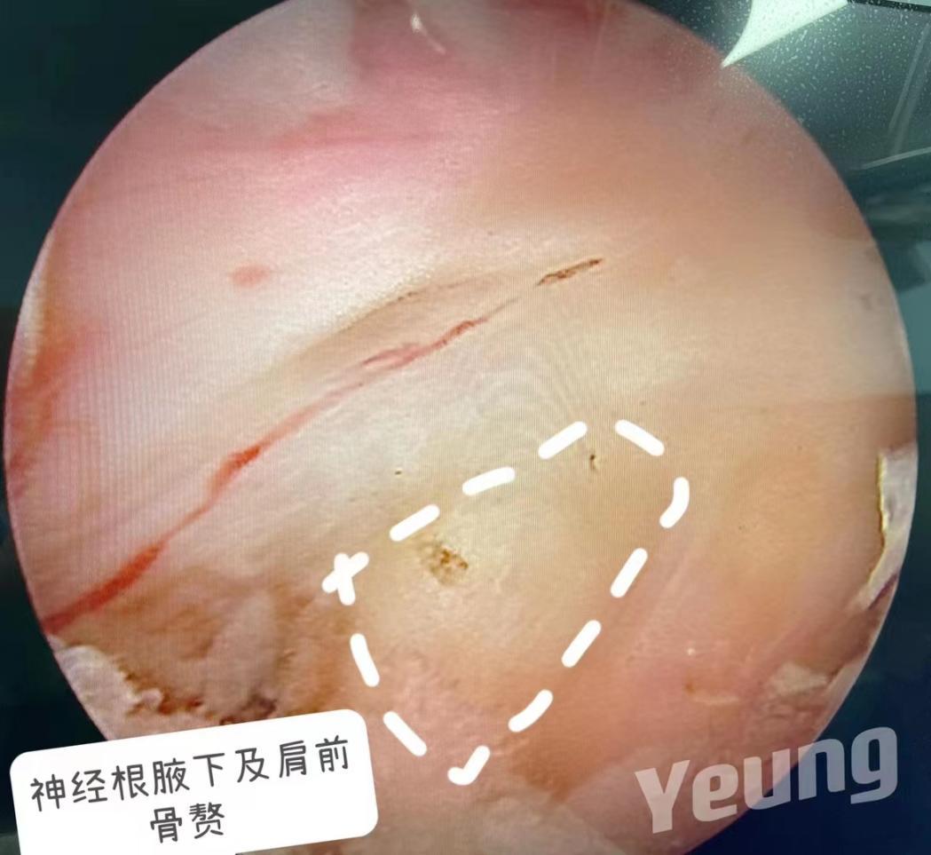 西安椎间孔镜手术治疗颈椎,西安红会医院微创