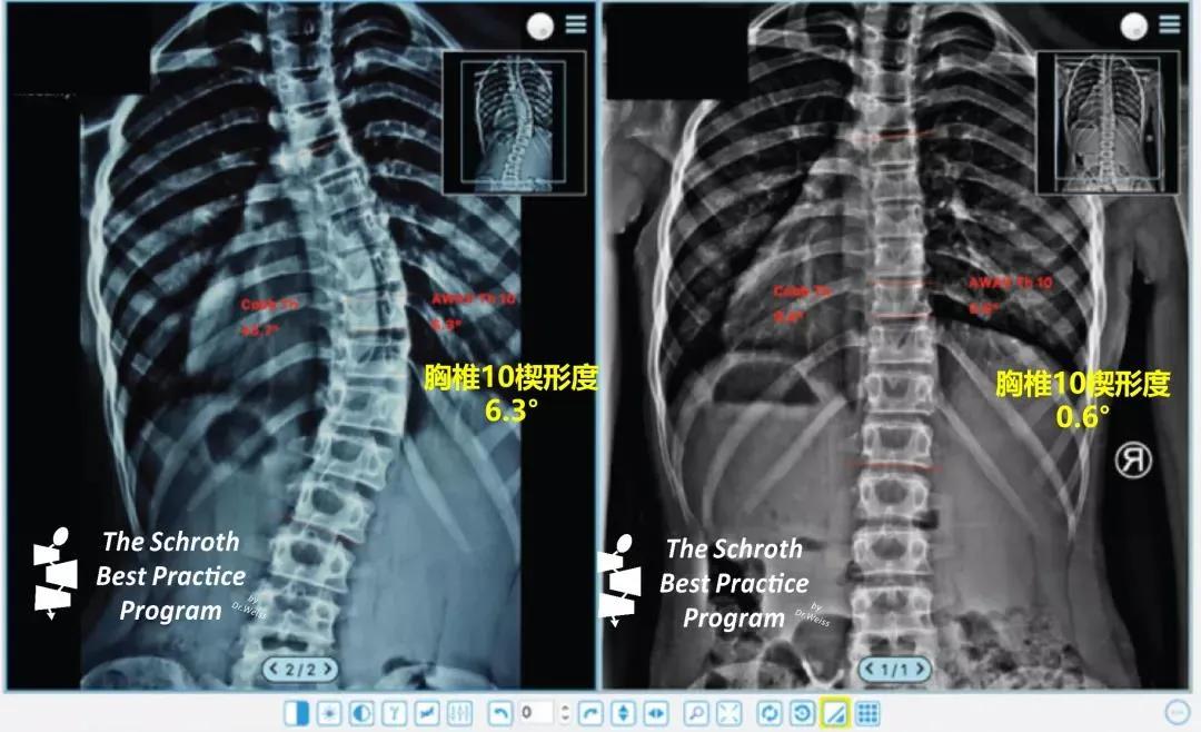 脊柱侧弯可以矫正过来吗,脊柱侧弯可以通过松解筋膜矫正吗