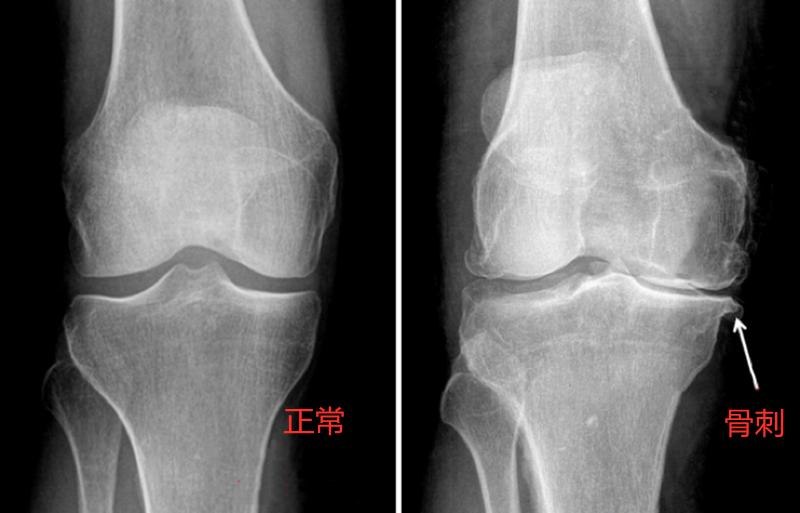 平甩功对膝盖长骨刺有好处吗,膝盖长骨刺是什么原因引起的