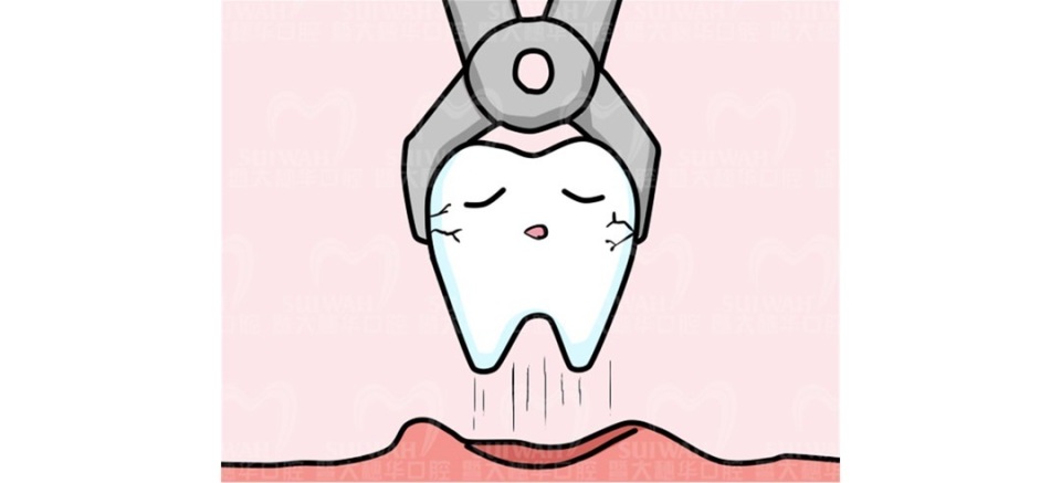 拔了下颚智齿后有个洞堆积残渣,智齿上面有个洞是补还是拔了好