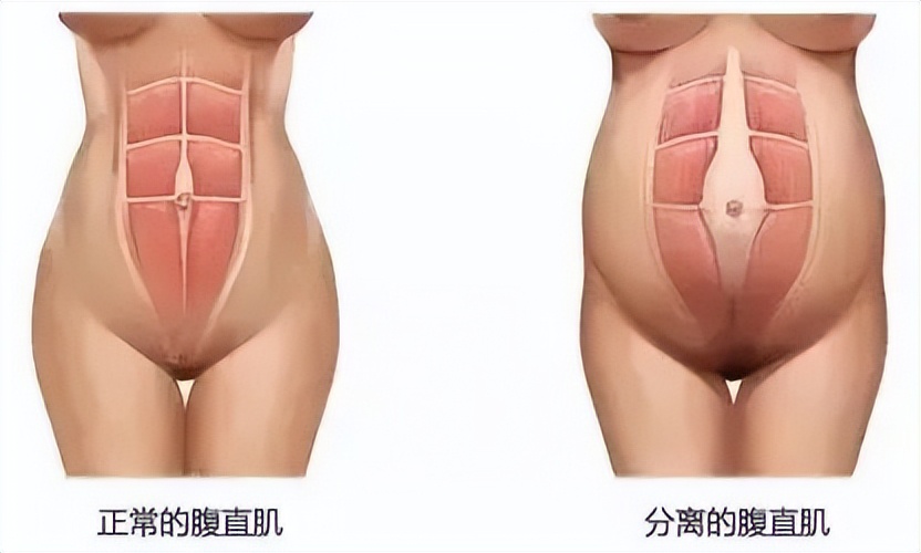 产后三个月能练刘畊宏吗,剖腹产多久可以练刘畊宏减肥操