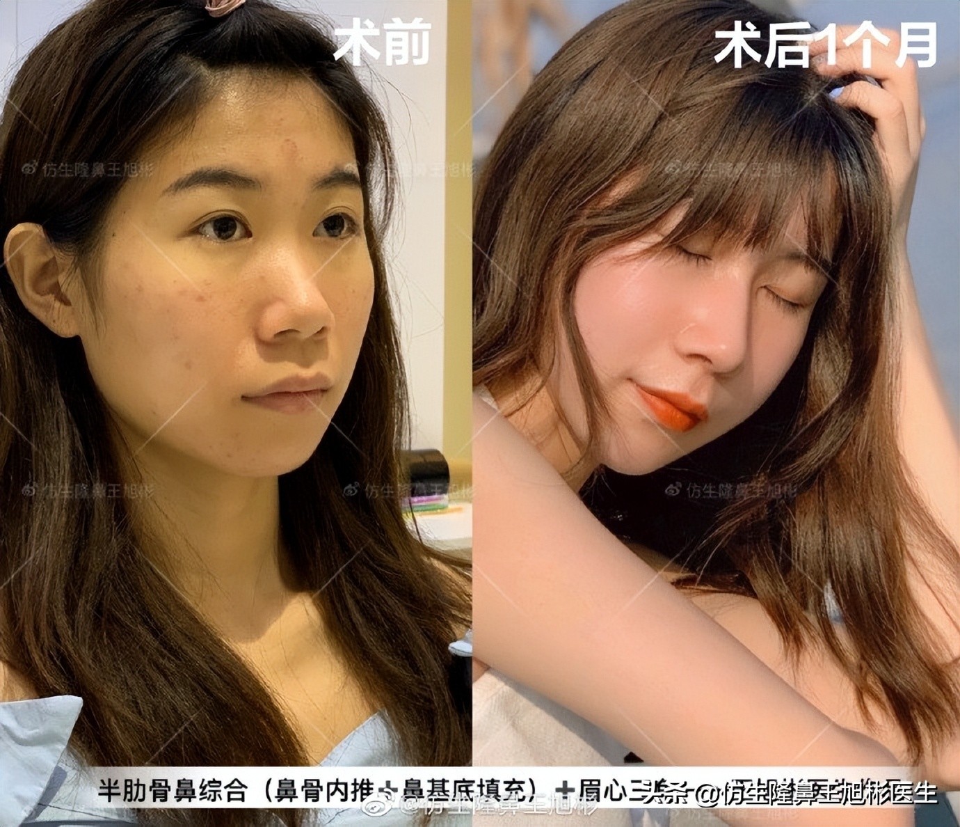 隆鼻鼻型科普,鼻基底凹陷隆鼻可以改善吗