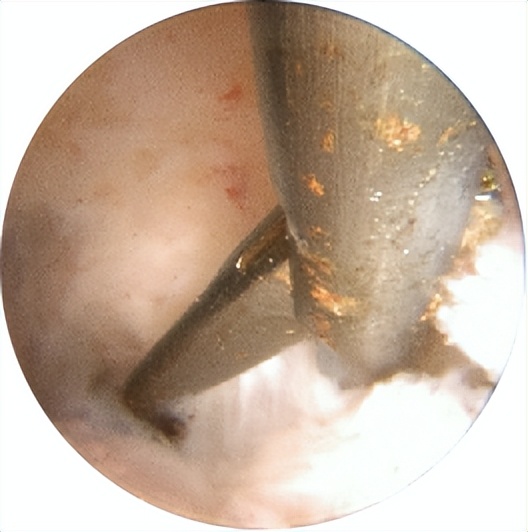 宫寒卵巢早衰月经量少怎样调理,月经量越来越少是要绝经了吗