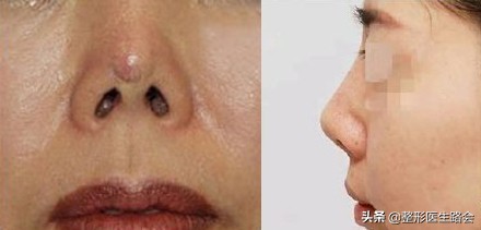 鼻子硅胶假体取出来真实感受,取出硅胶假体鼻子1-7天恢复过程图