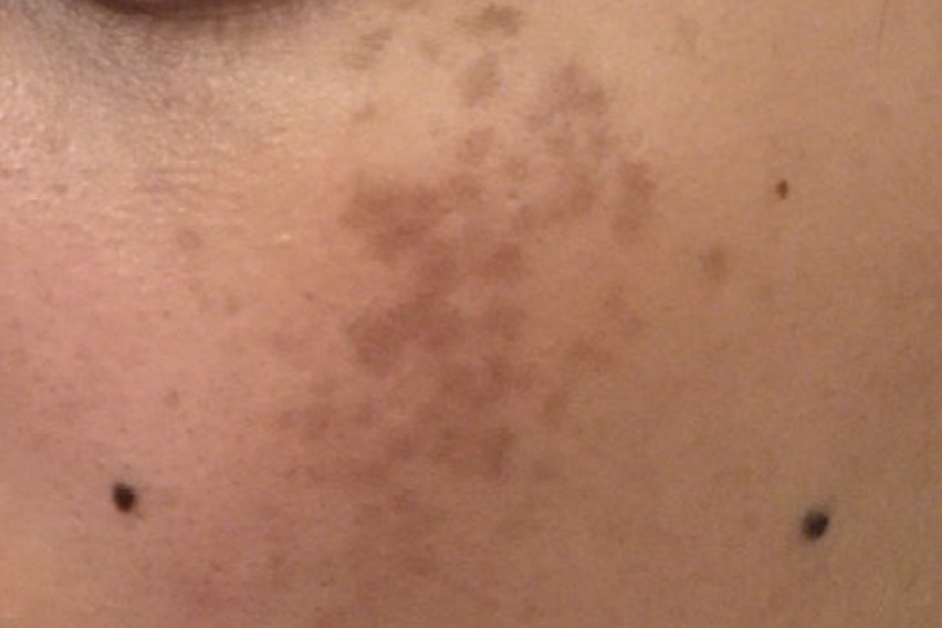 10岁女孩脸上长斑点怎么治,13岁男生脸上长褐色斑怎么治