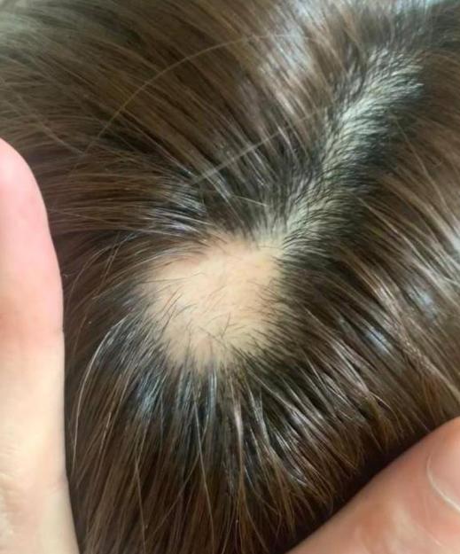 明星逃不过的脱发,明星也秃头还戴假发片