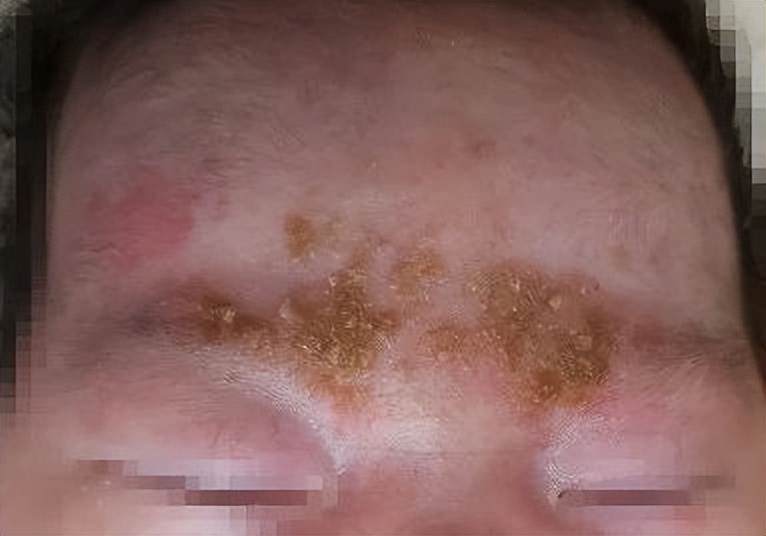 面部皮炎的症状和治疗方法,面部皮炎是怎么回事