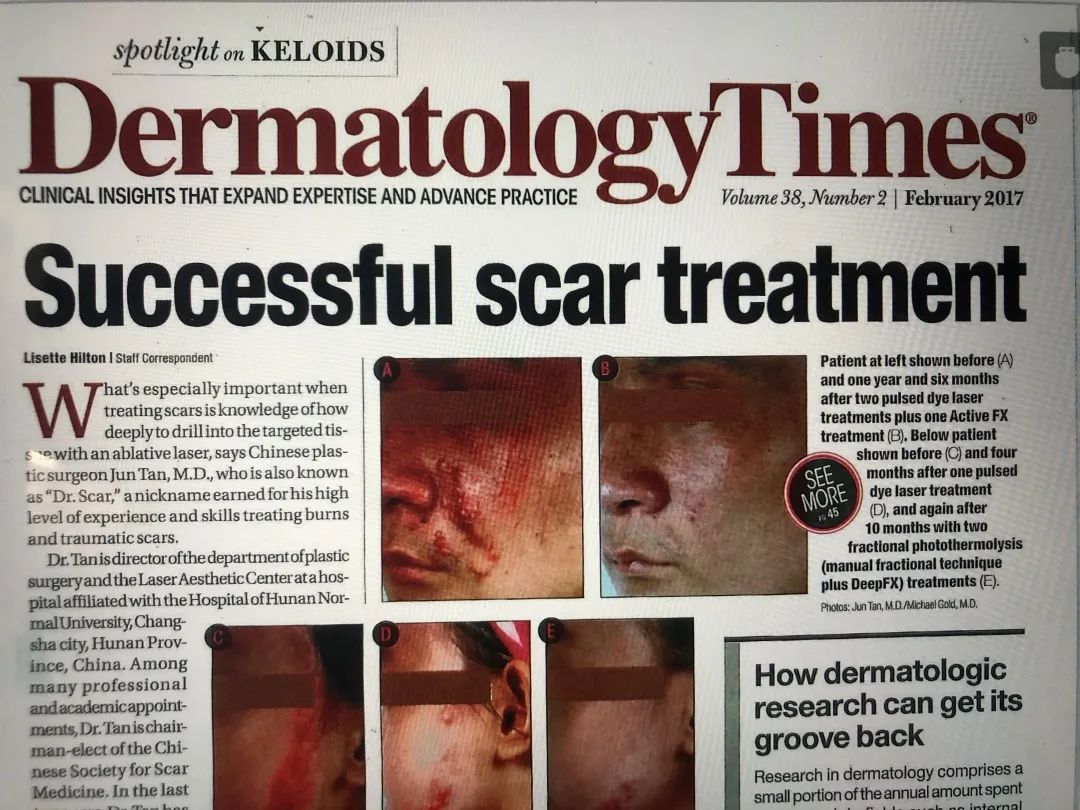 疤痕专家谭军,谭军医生治疤痕视频