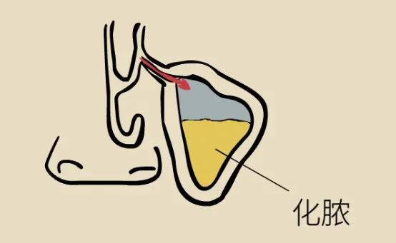 鼻窦发炎眼睛会持续疼还是偶尔疼,为什么得了鼻窦炎头很疼