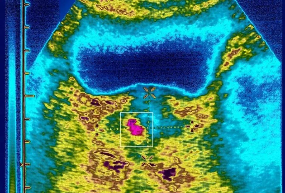 泌尿董博士,体检医生说前列腺钙化咋回事啊