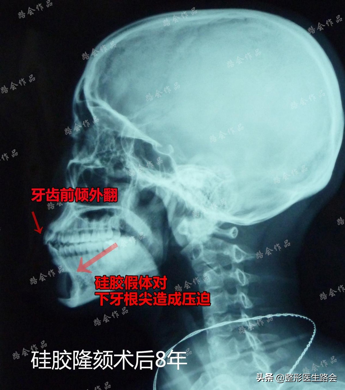 玻尿酸隆下巴吸收后会怎么样,玻尿酸注射下巴失败案例