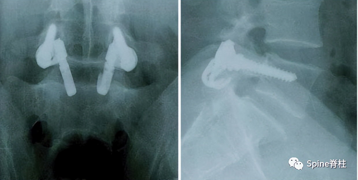 轻度峡部裂和重度峡部裂的区别,真性峡部裂和假性峡部裂