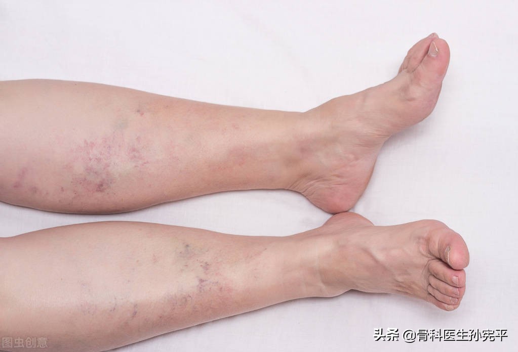 老年下肢水肿的原因和治疗,80岁老人下肢水肿原因