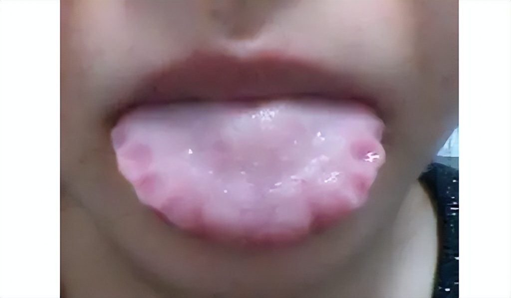 中医舌头胖大有齿痕中间有裂纹,舌头有齿痕看中医什么科