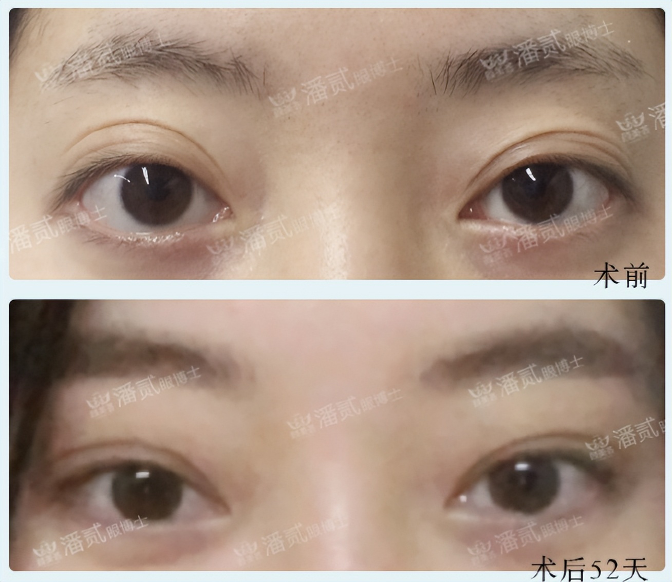 凸眼球显得眼睛大,凸眼眼窝凹陷