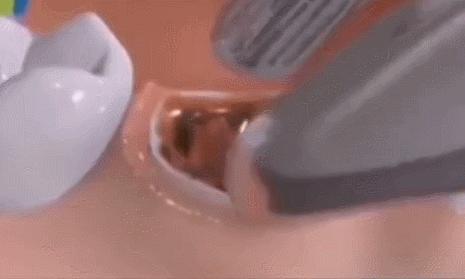 一块海绵多少钱,拔牙塞进牙洞里的海绵需要拿掉吗