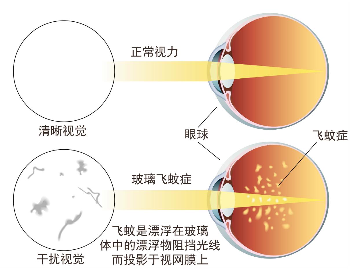 眼前只有一个小黑点算是飞蚊症吗,眼前有飞蚊症怎么办