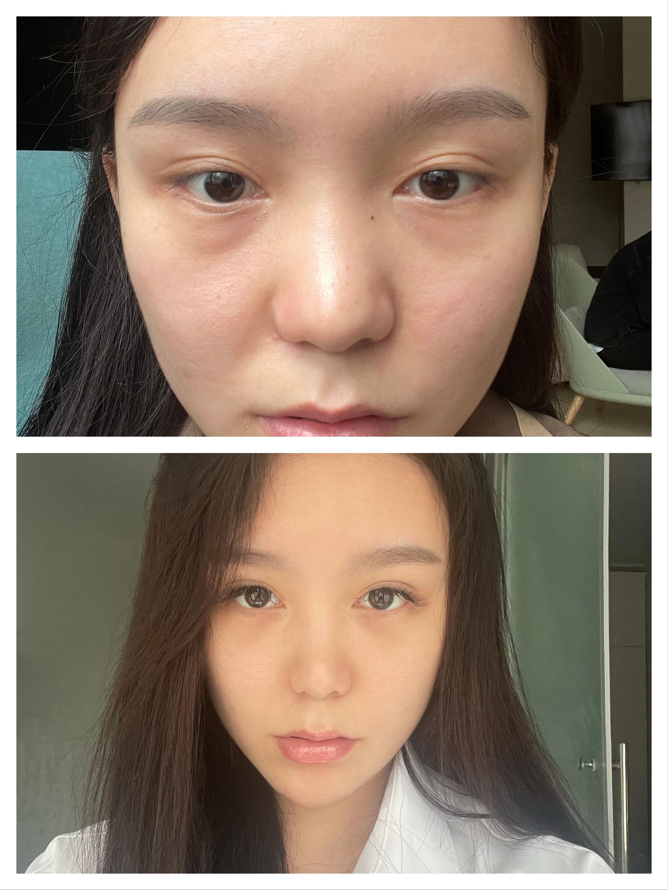 上海第九人民医院不开刀去除眼袋,顽固眼袋别担心不开刀也能变好看