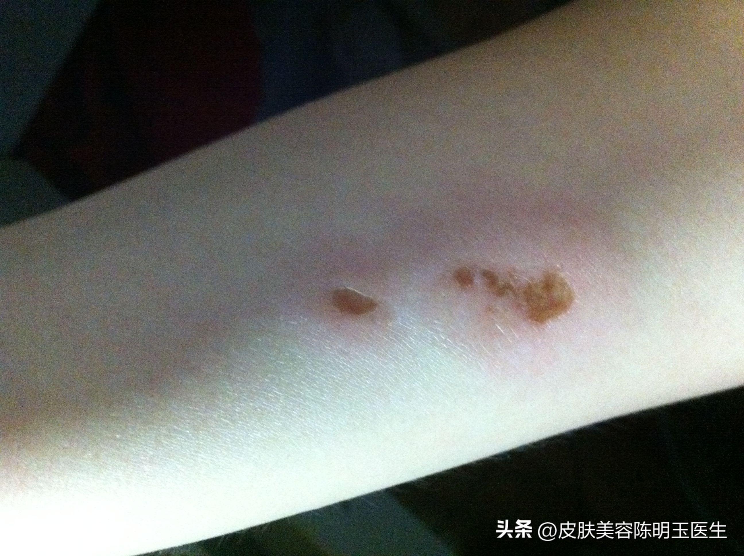 脖子上长小肉粒还能打hpv疫苗吗,50岁脖子上很多小肉粒是怎么回事