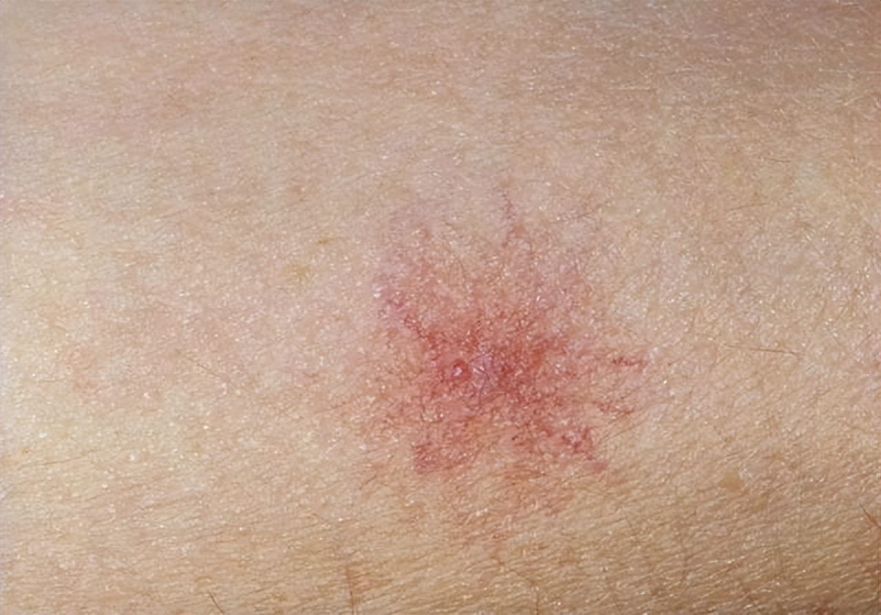 身体出现小红痣是什么原因引起的,身上起小红痣是肝病的信号吗