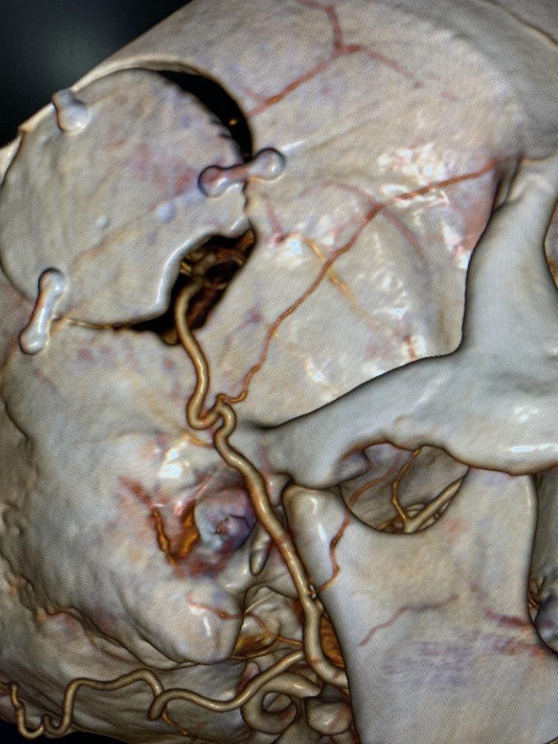 血管缝合200多针,脑血管搭桥手术2011年的成功率