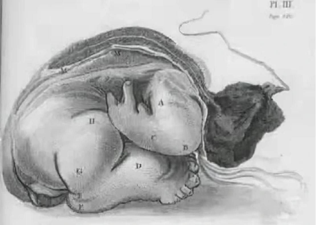 印度小伙意外怀孕,印度男子腹中神秘生物