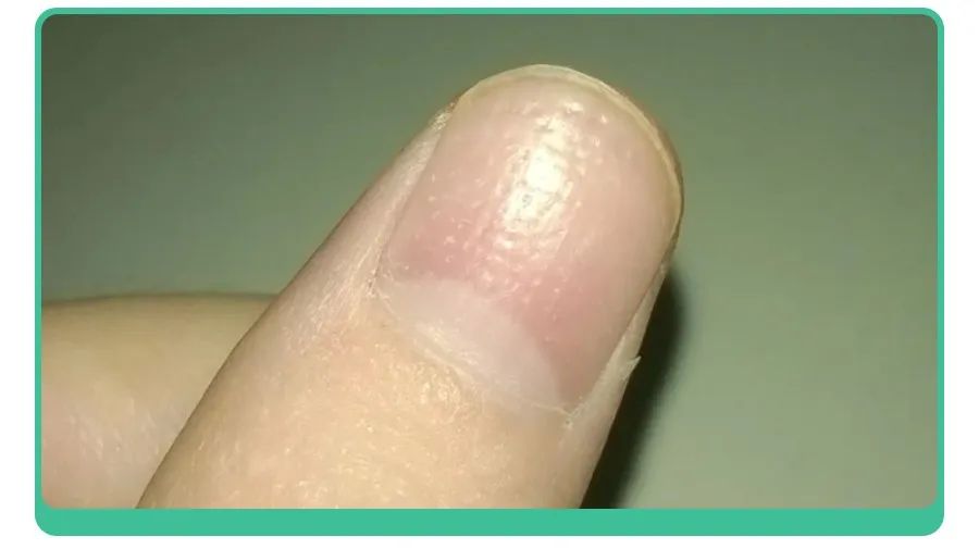 白斑、薄脆、凹陷，娃指甲有异常，不是缺营养，可能暗藏疾病