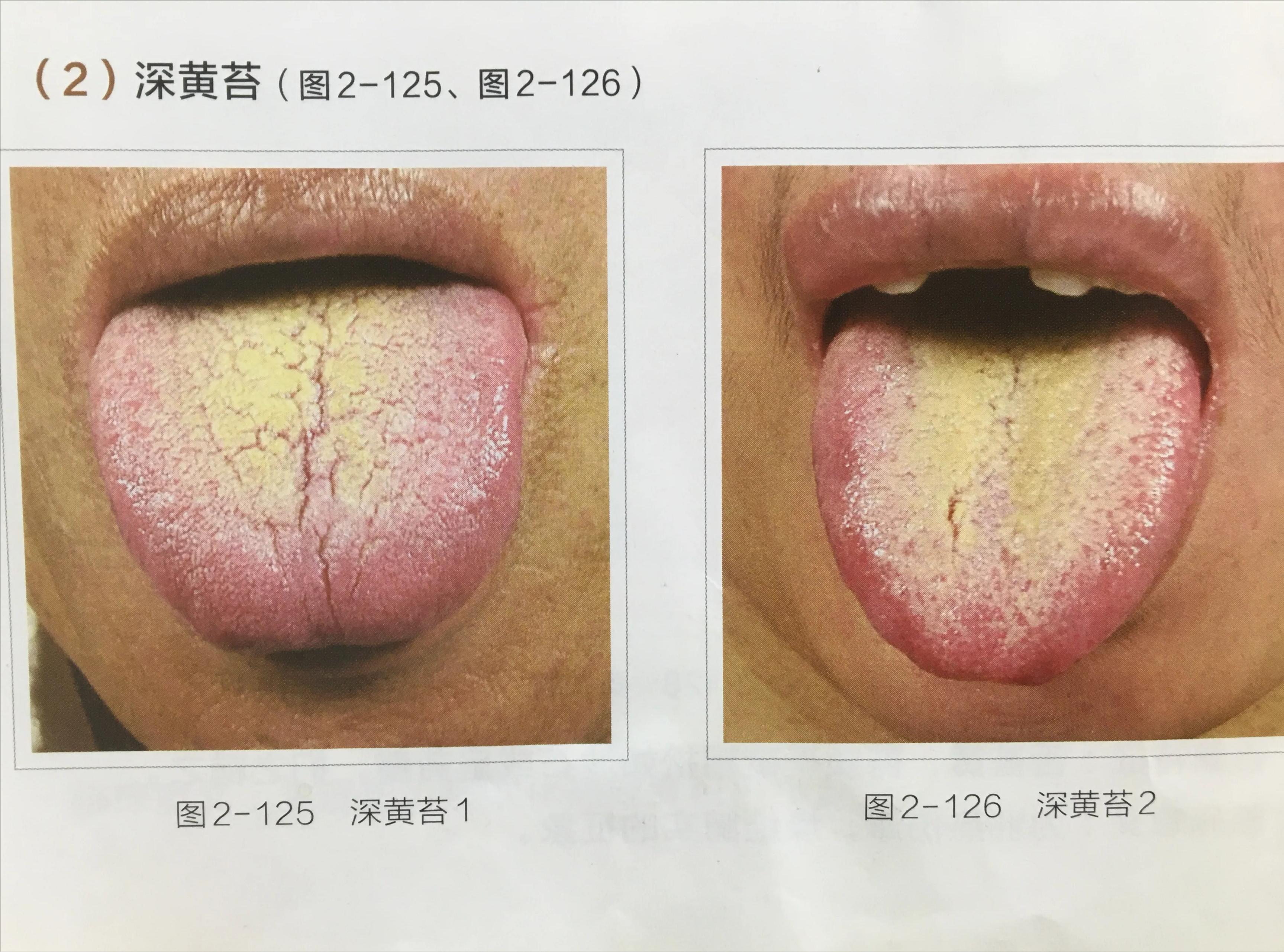 苔白舌诊与疾病对照图,舌诊中舌质红且有苔