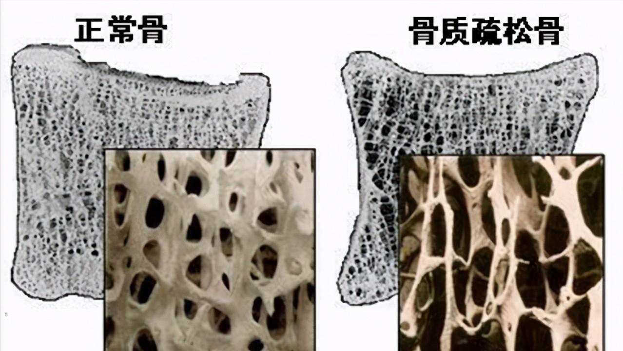 老年人弯腰驼背怎么治,老人弯腰驼背怎么回事