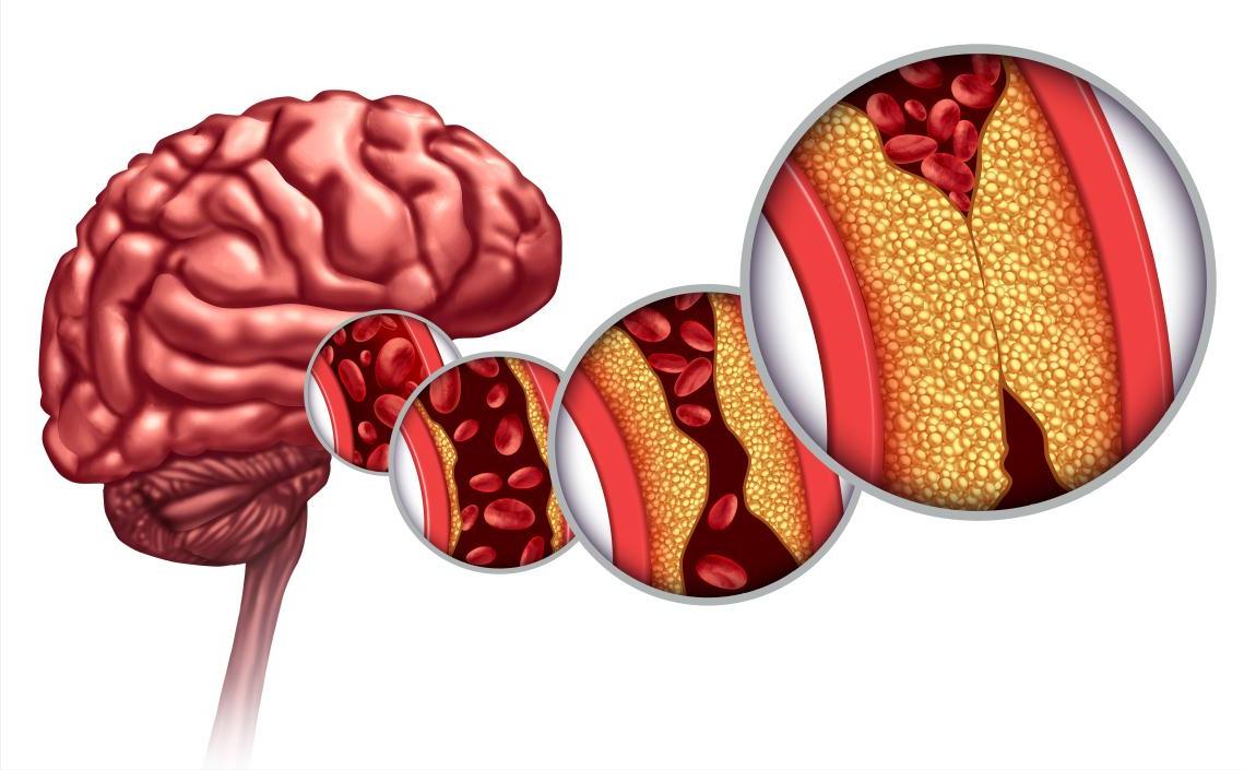 年轻人突发脑梗,为啥年轻人发生心梗脑梗越来越多