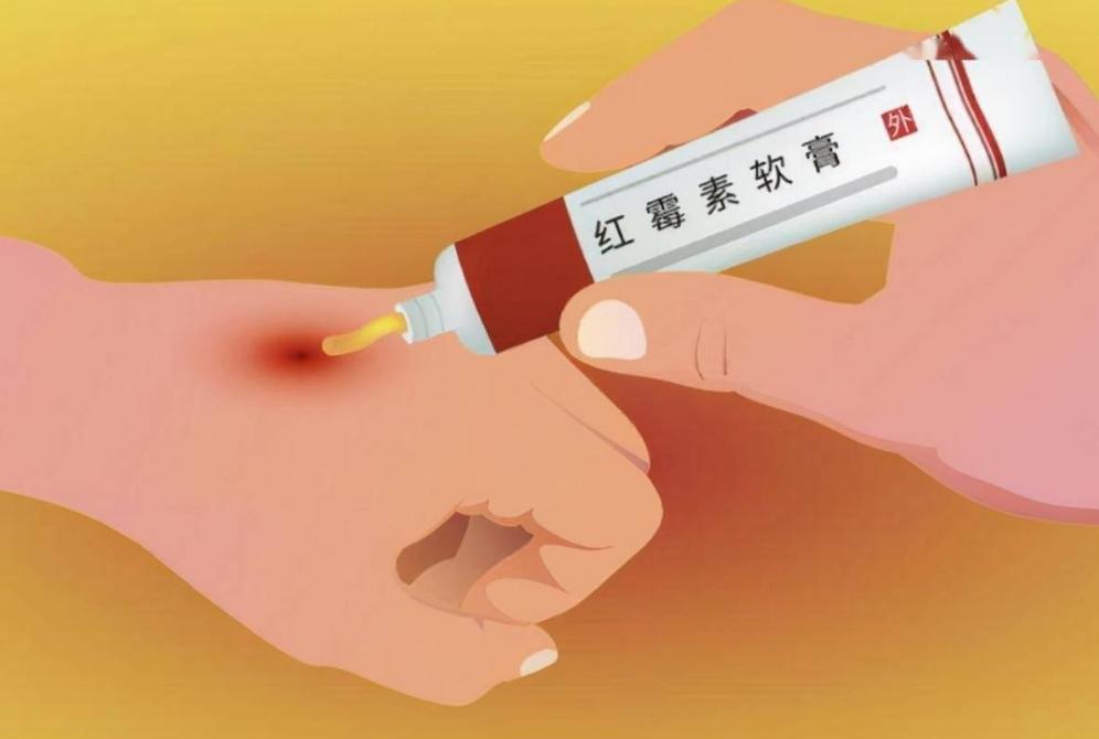 红霉素软膏与姜末祛老年斑有用吗,红霉素软膏能淡化老年斑吗