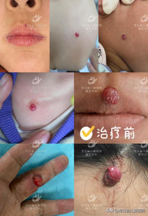 挤不出来的痘痘,挤毛孔粗大痘痘