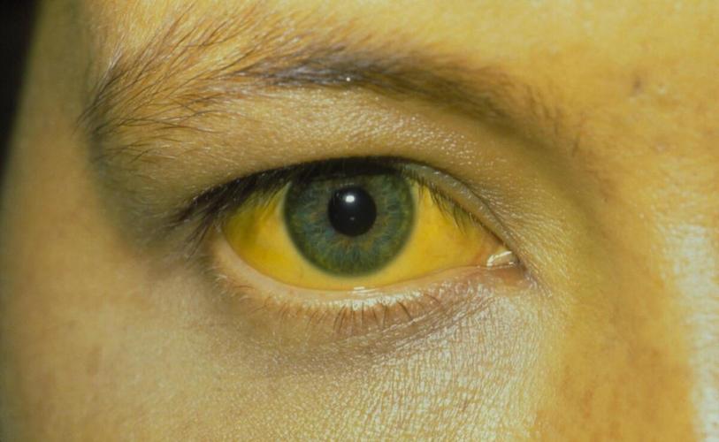 腹腔镜下胆总管切开取石治疗,充填型胆囊结石用腹腔镜怎样切除