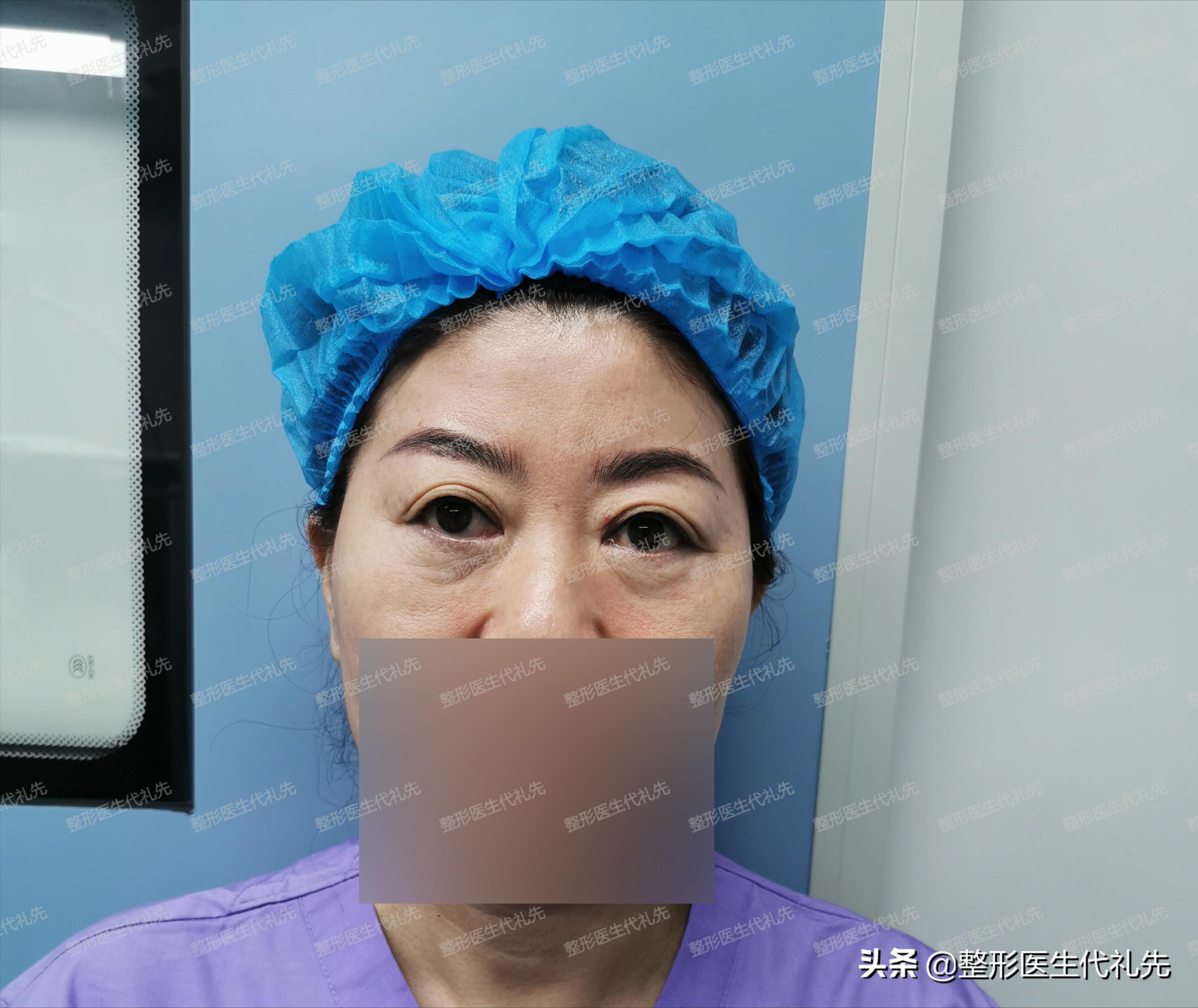 全切双眼皮5个月修复调整全过程,全切双眼皮个人恢复过程经历真实