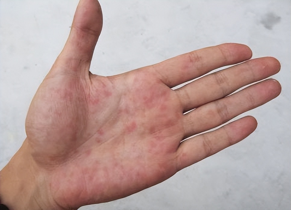 肝不好会出现一些信号,肝不好的人手上会出现哪六个暗示