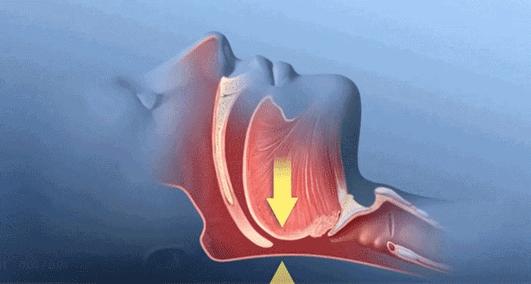 打呼不是病打起来要人命,打呼是一种病吗怎么治