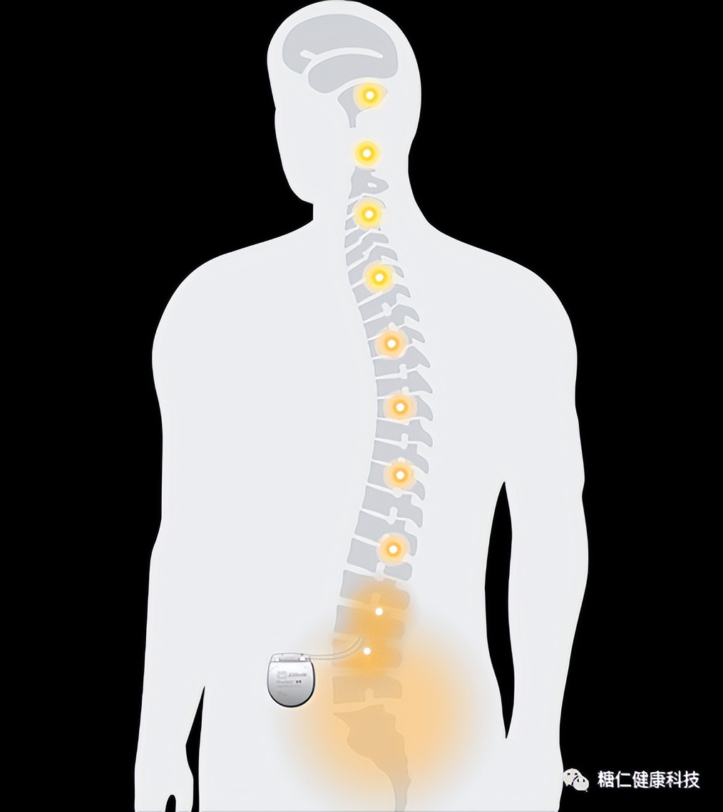 fda批准治糖尿病,fda批准的阿尔兹海默症药物