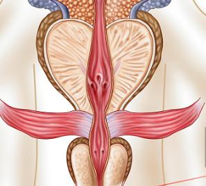 神奇的粒子—前列腺癌患者纷纷点赞的125I粒，术后三天即可出院。