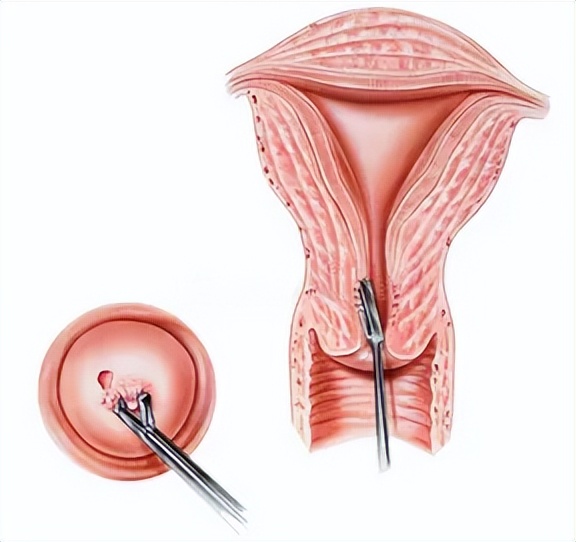 妇科hpv活检要割肉吗,妇科内检需要夹肉化验吗