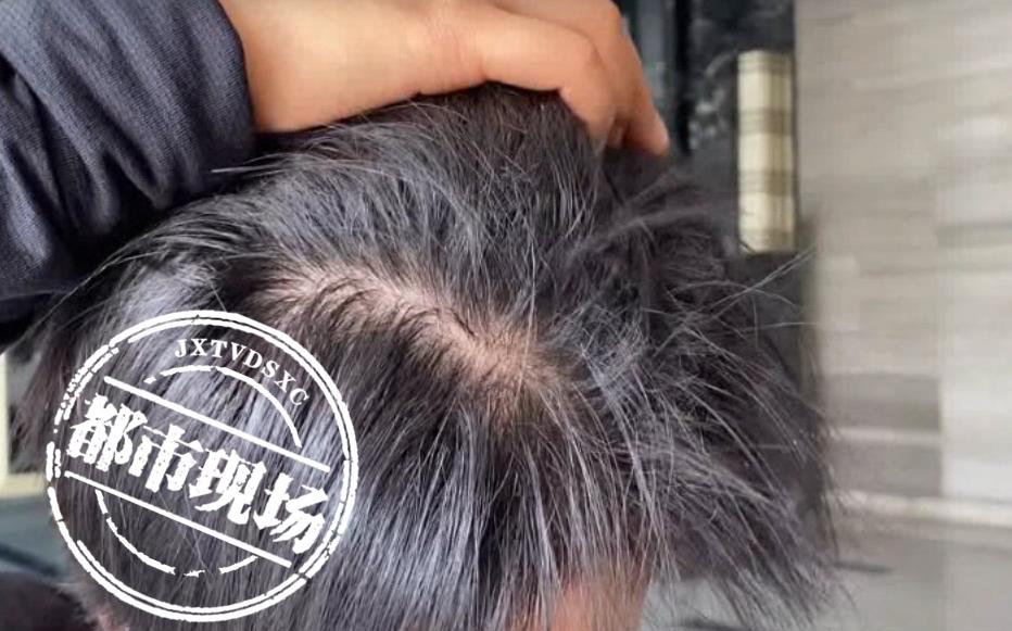 女子染发接发8小时后续,女生花1500染发结果秃了