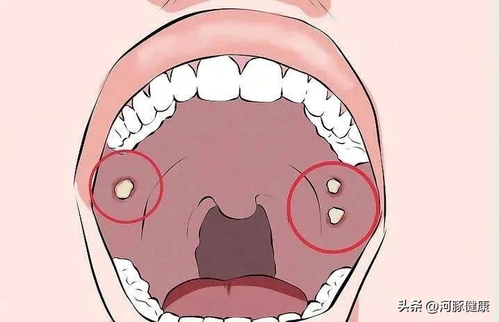 长期口腔溃疡一直不愈是癌吗,口腔溃疡不管它一般几天就能自愈