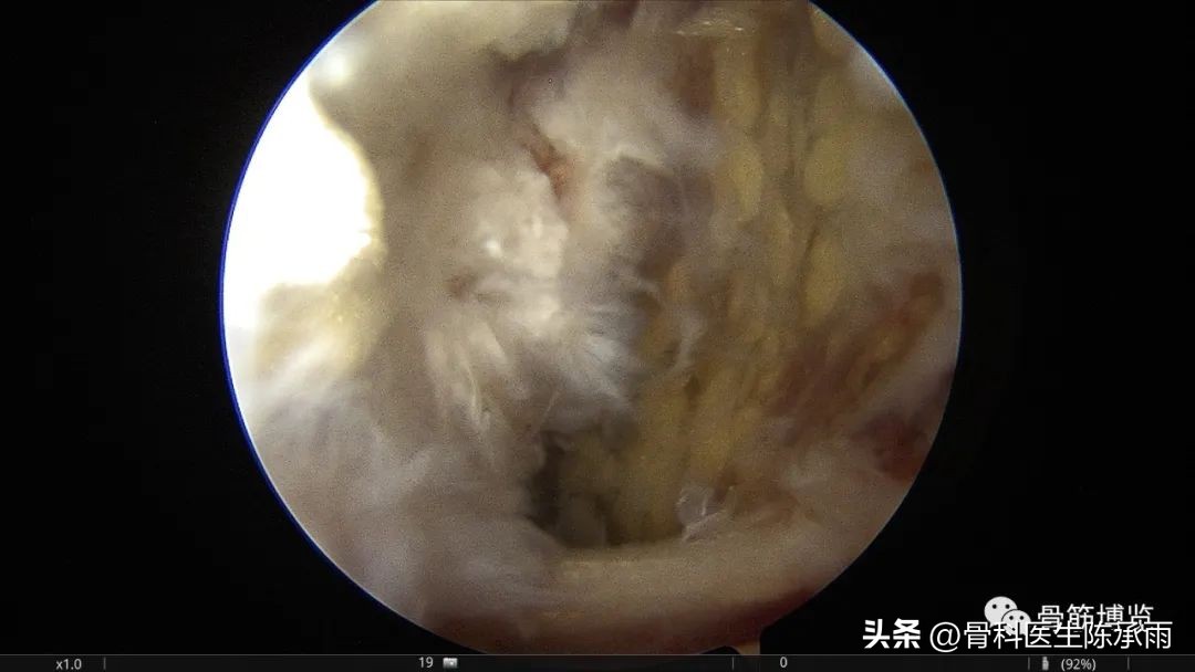 腘窝囊肿关节镜下切除复发,膝关节镜下腘窝囊肿切除的原理